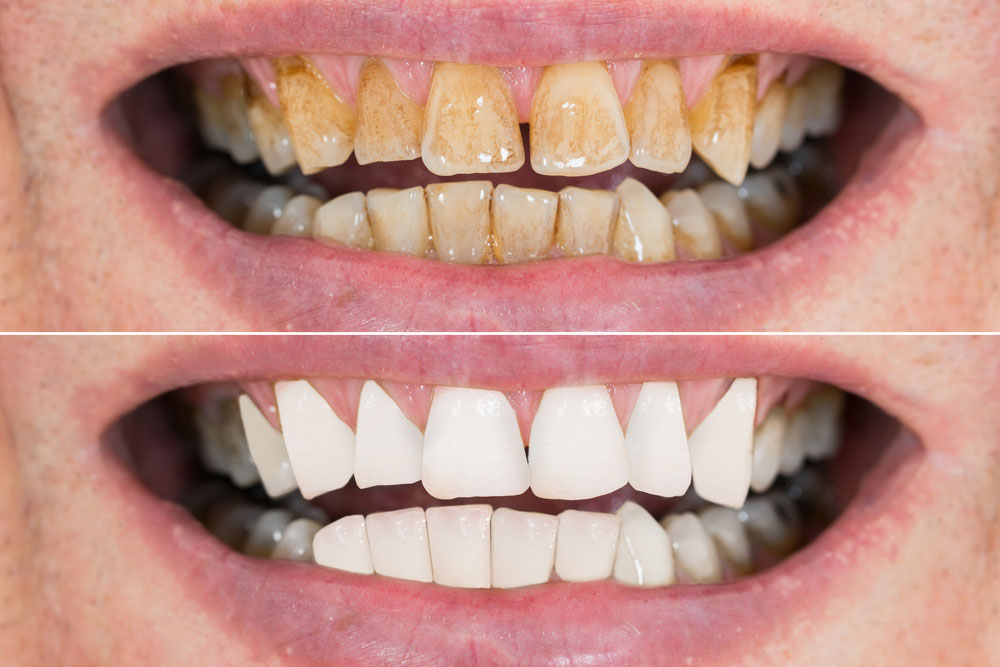 Close-up Detail Of Man Teeth Before And After Whitening